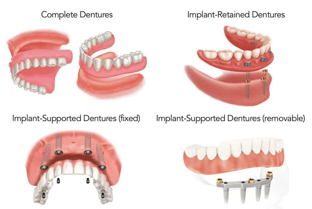Tipos de protesis dentales, claves para una sonrisa excelente