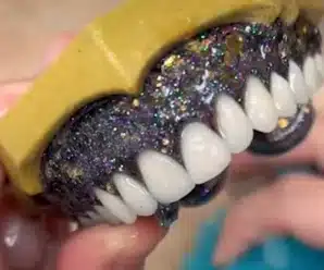 Glitter Dentures Sparkle and Shine: Exploring for a Dazzling Smile