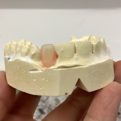 Dental Flipper/Tooth Replacement Online